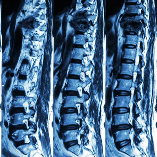 MRI Lumbar Spine with Contrast